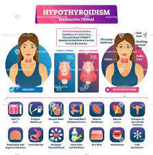A comparison of 5469 cytological and final 149. Hypothyroidism Hormone Produce Infographic Vector Illustration Hypothyroidism Hyperthyroidism Thyroid