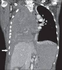 Leung an, müller nl, miller rr. Malignant Pleural And Peritoneal Mesothelioma Consequential To Brief Indirect Asbestos Exposure Journal Of Clinical Imaging Science