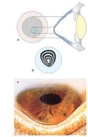 Keratoconus Showing A Configuration Of Cone Shaped Cornea B Irregular Circles On Placido Disc Examination C Clinic Lasik Eye Surgery Eye Surgery Lasik