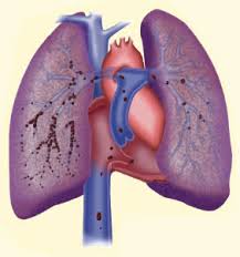 Arterial embolism of the extremities and technique of embolectomy. Embolia Pulmonar Aguda Articulos Intramed