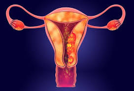 These signs can change depending on the growth of the cancer. Uterine Endometrial Cancer Symptoms Staging Treatment Risk Factors