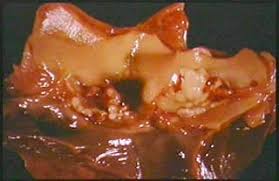 Image result for Group D Streptococcus