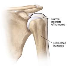 Image result for Chronic Shoulder Dislocation