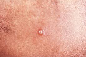 Image result for chancroid