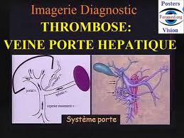 Thrombose De La Veine Porte Hepatique Diagnostic Imagerie Youtube