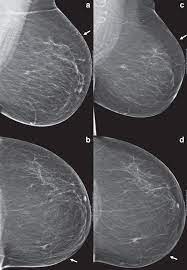 Breast cancer is the most common cancer in the uk, accounting for 15% of all new cancer cases (2017). Delayed Breast Cancer Diagnosis After Repeated Recall At Biennial Screening Mammography An Observational Follow Up Study From The Netherlands British Journal Of Cancer