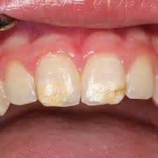 #brusko #snus #easysnus #strongsnus #70mg #снюс #крепкийснюс #бруско #корвус #кидайтеснюсанепацанов. Kreidezahne Durch Weichmacher Im Plastik Ndr De Ratgeber Gesundheit