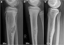 Bone cancer is when unusual cells grow out of control in your bone. Bone Tumor Wikipedia