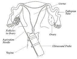 Fast facts about the ivf egg retrieval procedure. The Medical Procedure Of Egg Donation