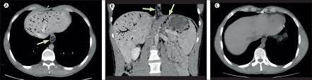 Hydrogen Peroxide Poisoning The Lancet Gastroenterology Hepatology