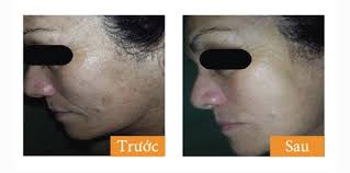 Máy IPL đa năng AI: all in one- IPL, RF, siêu mài mòn, ISRAEL