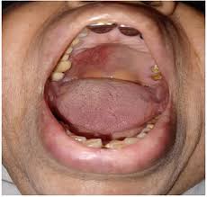 Image result for Oral herpes roof of mouth
