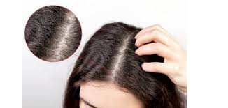 أفضل طريقة للقضاء على بيض القمل إستشاري