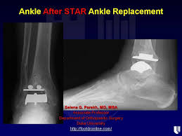 Ankle After Star Ankle Replacement Ankle Replacement Orthopedic Surgery Holistic Approach