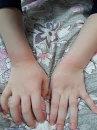 Allergiya Na Mylo 14189575 Kashalot