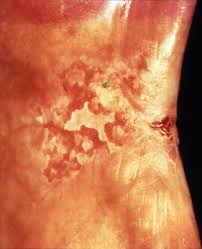 Image result for Erythroplakia roof of mouth