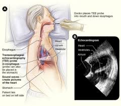 Tee synonyms, tee pronunciation, tee translation, english dictionary definition of tee. Transesophageal Echocardiogram Tee Stanford Health Care