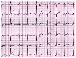 Image result for Early Repolarization
