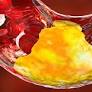 Cholesterol Management: Lifestyle First, Medication as Essential Backup