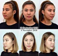 I used the restroom before the procedure because i was nervous. Buccal Fat Removal What You Should Know Signature Clinic