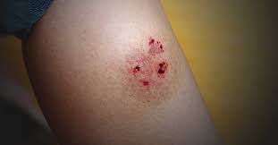 Image result for Dog Bite