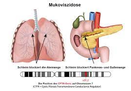 Es gibt keine bekannte heilung für mukoviszidose. Zystische Fibrose Mukoviszidose Ambulante Pflege Bei Mukoviszidose Gip Intensivpflege