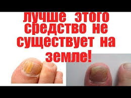 как вылечить грибок на ногтях ног в домашних условиях Pin Na Doske Dlya Obrazovaniya Detej