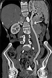 Imaging Appearance And Nonsurgical Management Of Pelvic Venous Congestion Syndrome Radiographics