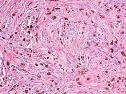 Image result for Blue Nevus