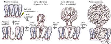 Pathophysiology of Colorectal Cancer