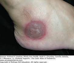 Image result for Fixed Drug Eruption