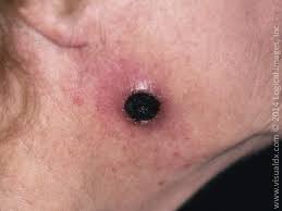 Skin around the eschar may be red, swollen, or tender. Learnderm Eschar