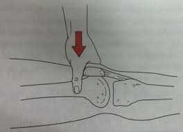 Image result for Ballottable Patella Sign