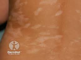 Image result for Postinflammatory Hypopigmentation