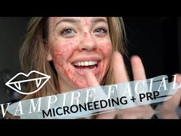 GET THE VAMPIRE FACIAL W/ ME + BEFORE & AFTER