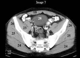 Case contributed by assoc prof craig hacking. Http Gamma Wustl Edu Docs Ct Transverse Anatomy Pdf