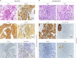 The early symptoms of lung cancer may be a slight cough or shortness of breath, depending on which part of the lung is affected. Small Cell Lung Cancer Nature Reviews Disease Primers