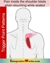 Pin On Upper Back Trigger Point Pain