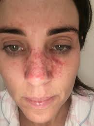 This page lists cancer drugs approved by the food and drug administration (fda) for skin cancer, including drugs for basal cell carcinoma, melanoma, and merkel cell carcinoma. Cancer Face Denai Kulcsar Interiors