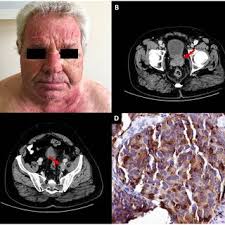PDF) Co-occurrence of Dermatomyositis and Polycythemia Unveiling Rare de  Novo Neuroendocrine Prostate Tumor