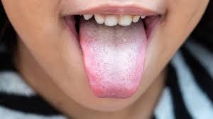 Image result for Oral thrush roof of mouth