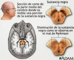 Una epidemia es más que un número normal de casos de enfermedad, el comportamiento específico relacionado con la salud u otros eventos relacionados con la salud en «realmente es una semántica límite, para ser honesto», dijo fauci. Que Es El Parkinson