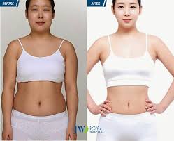Ngay sau khi được chia sẻ, đoạn clip của youtuber này đã nhanh chóng thu hút được sự quan tâm của đông đảo người dùng, cùng với đó là nhận được số lượt chia sẻ nhiều tới chóng mặt. Hut Má»¡ Bá»¥ng Khong Pháº«u Thuáº­t Chi Phi Tháº¥p An Toan Khong Ä'au