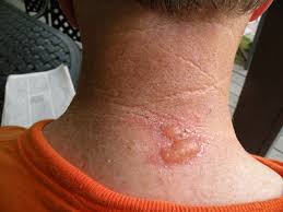 If you're asking is this a spider bite? the answer is almost certainly no. Gallery Of Dangerous Spider Bite Photos