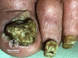 Image result for Onychogryphosis feet