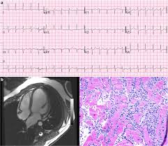 Myocarditis is an inflammatory disease of the myocardium that may present with sudden cardiac death, symptoms mimicking myocardial infarction, heart rhythm and conduction disorders, and heart failure. Figure 1 Cardiotoxicity Of Immune Checkpoint Inhibitors Springerlink