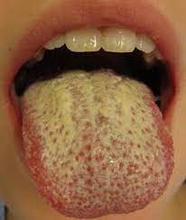 Remedies For Thrush 5 Natural Remedies For Thrush Natural Asthma Remedies Yeast Infection Treatment Candida Diet