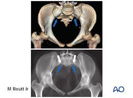 Maybe you would like to learn more about one of these? Planning For Is Screw Insertion