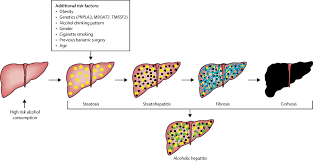 Outpatient Management Of Alcohol Related Liver Disease The Lancet Gastroenterology Hepatology