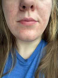 What can I use to relieve skin soreness around the nasal mask area while  using a CPAP machine?